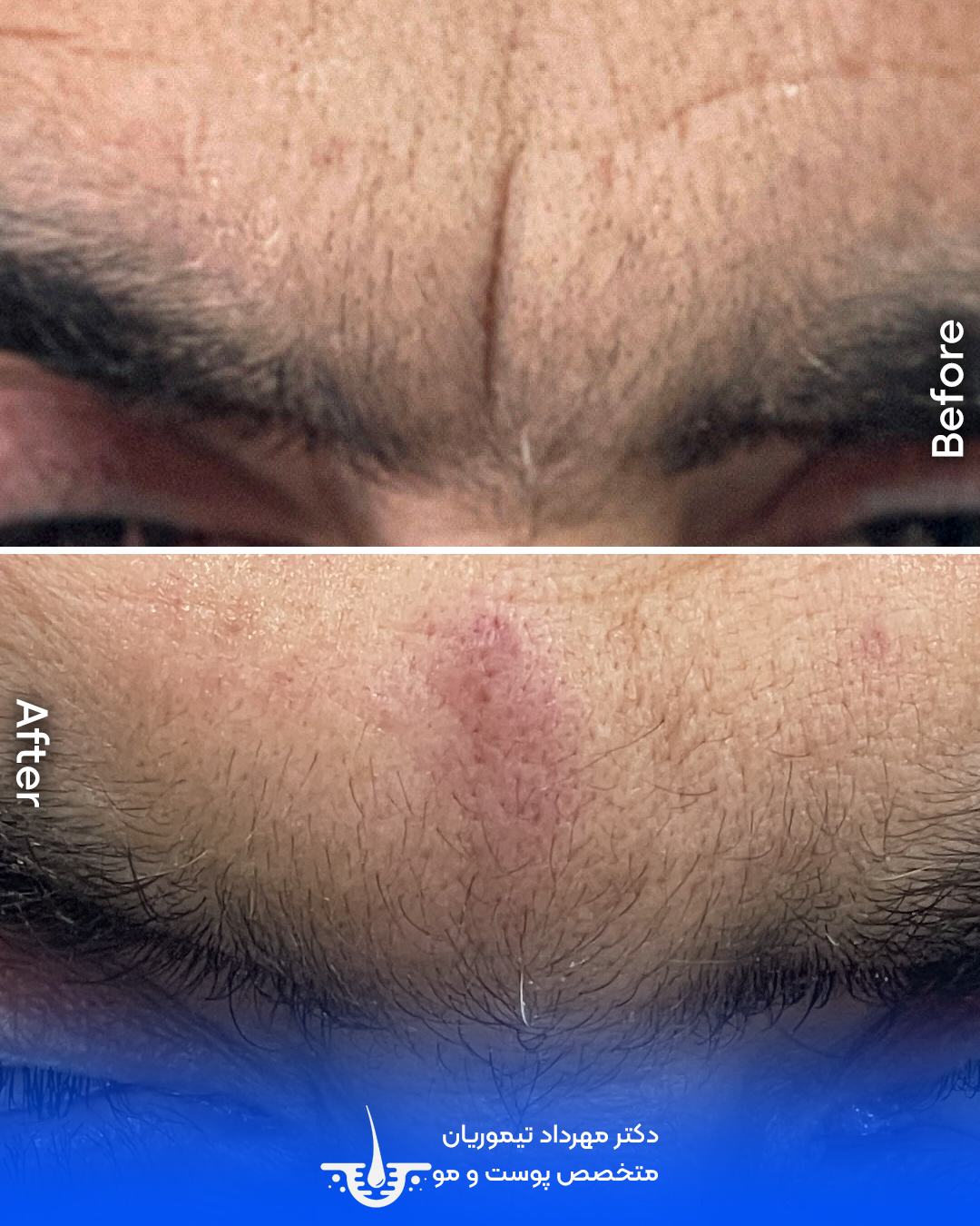 بهبود خط اخم با تزریق فیلر در گرگان